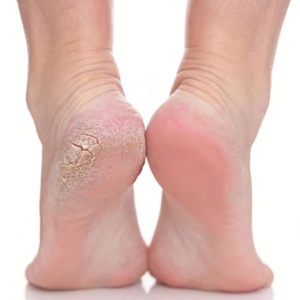 Exfoliating Socks au Maroc