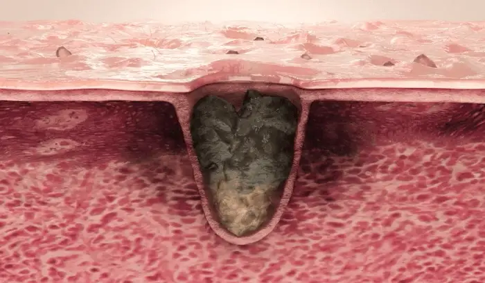 pads pores dilatés peau grasse